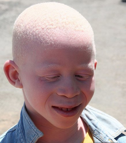 albinolarda göz sağlığı